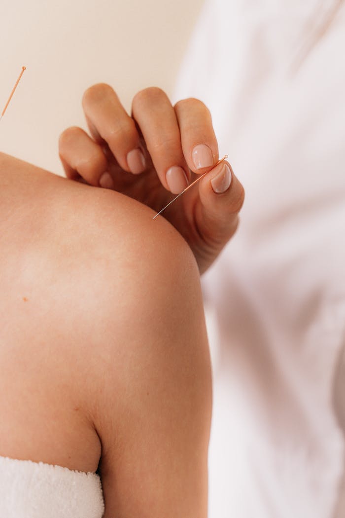 Services-03 Close-up of acupuncture needle therapy on a patient's shoulder illustrating alternative medicine.